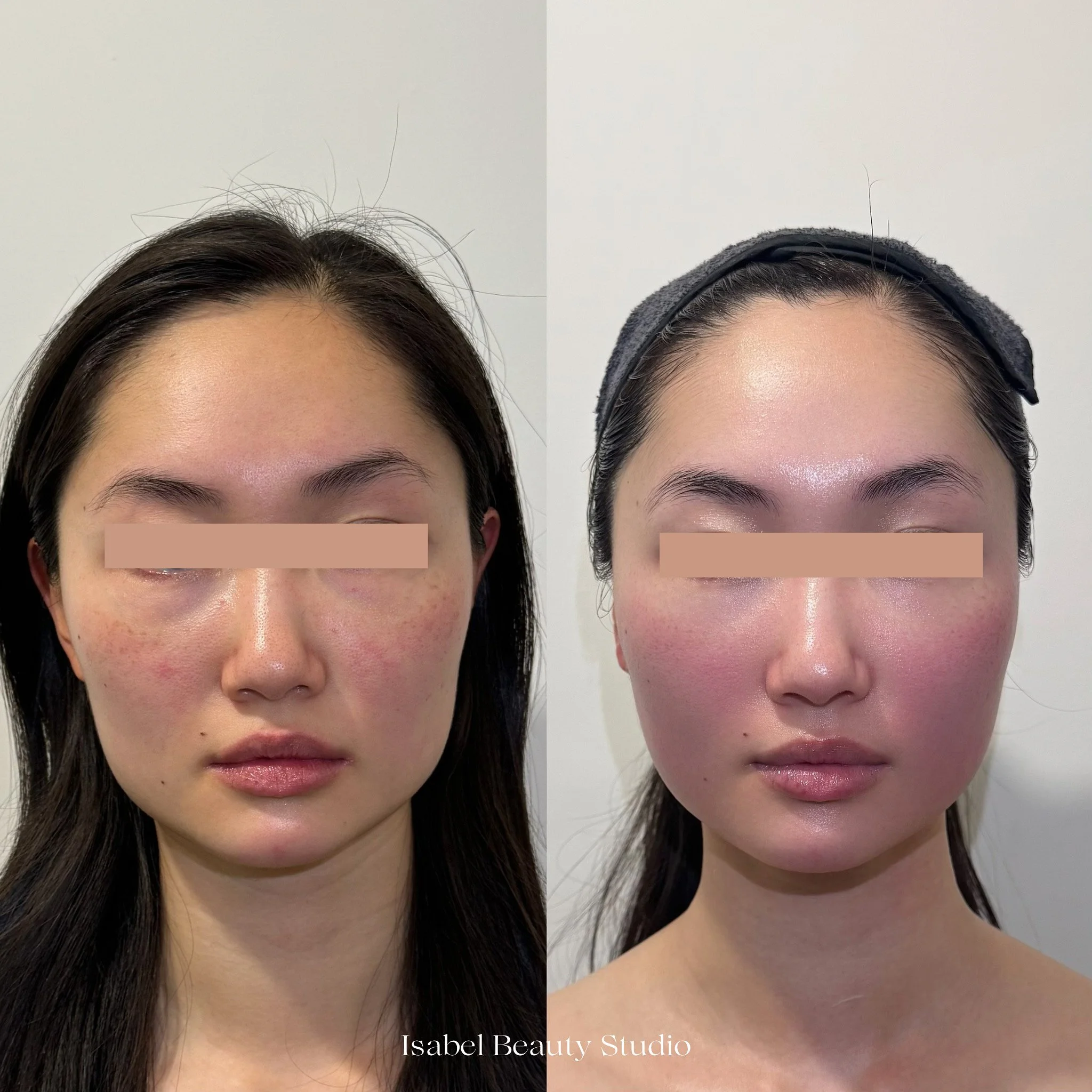 Before-and-after comparison of a woman’s facial skin, showing visible redness and uneven texture before and a smoother, more even complexion afterward.