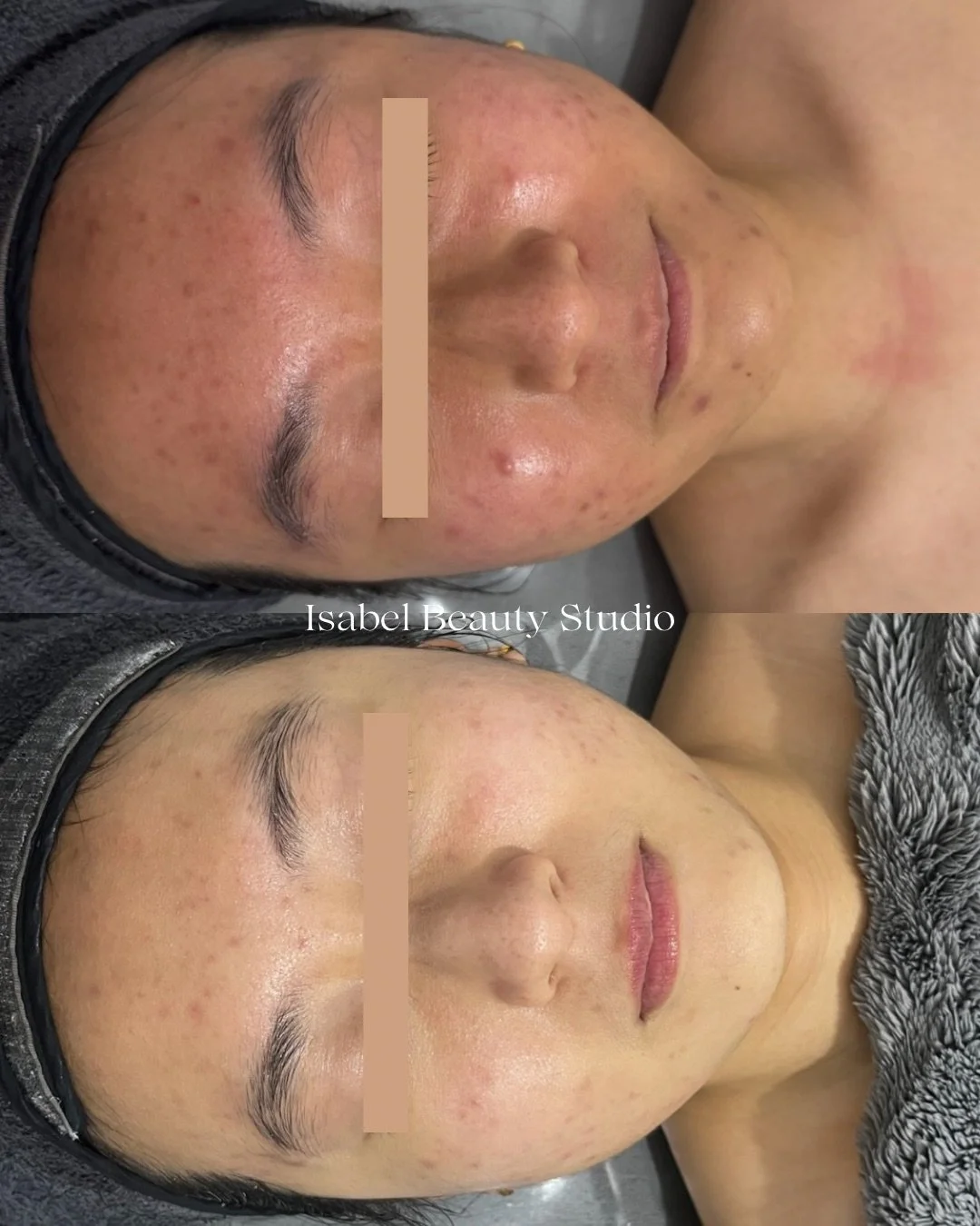 Before-and-after skincare treatment photos showing reduced facial acne, redness, and dark spots.