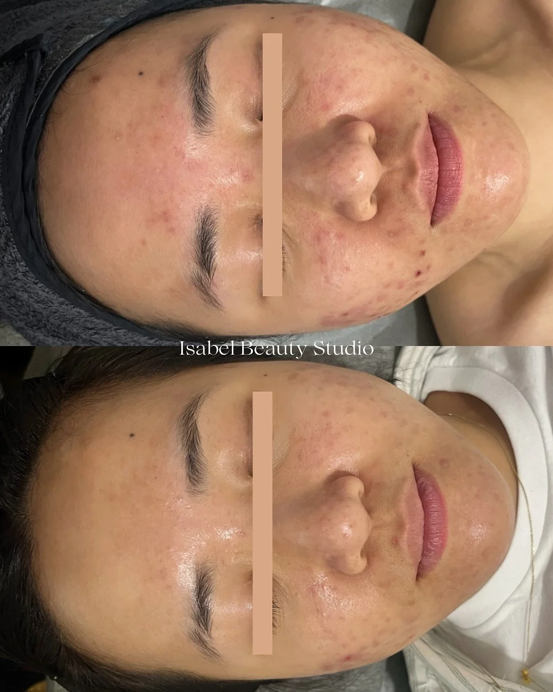 Before-and-after facial skincare photos showing reduced acne and improved skin texture and redness.