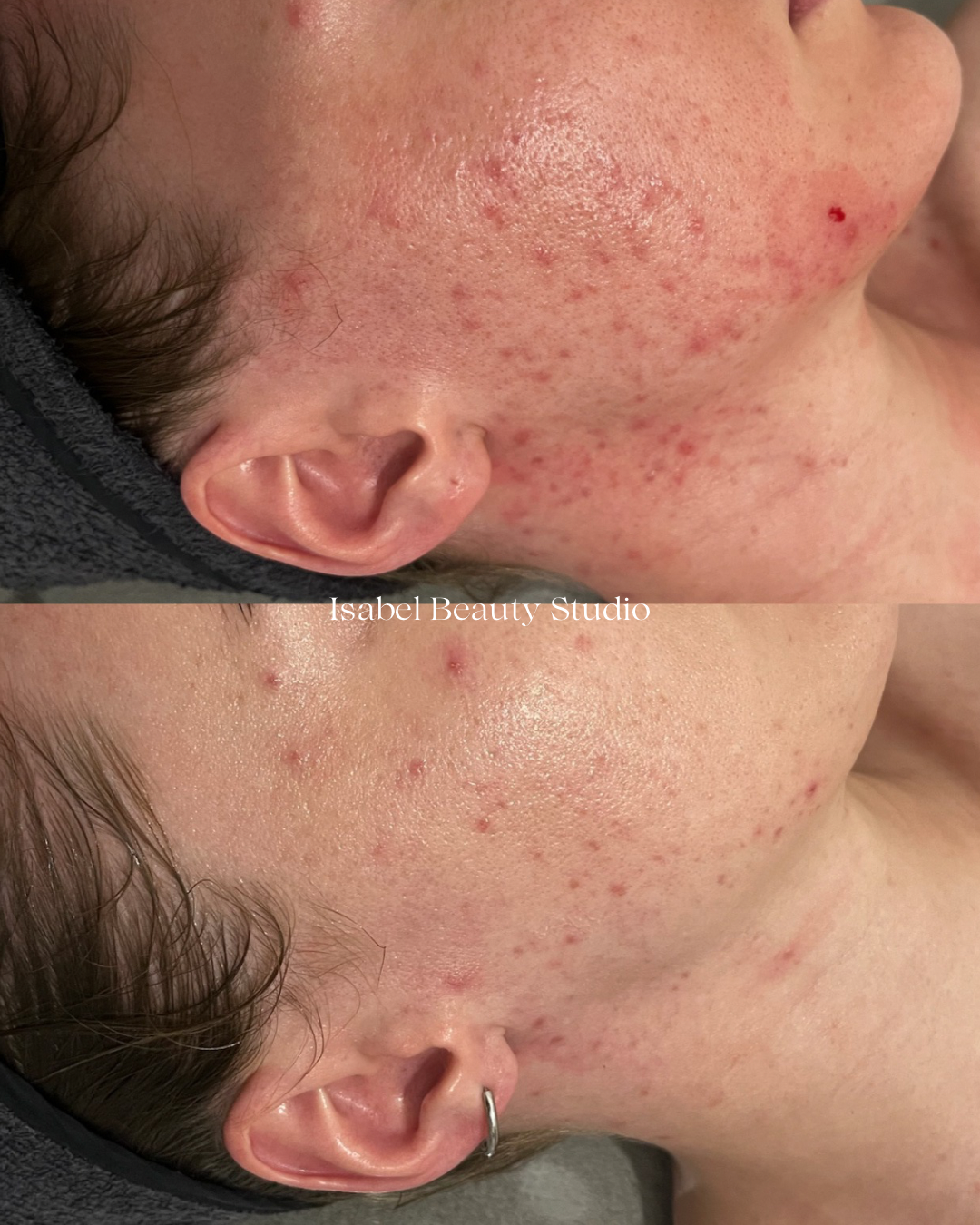 Before-and-after close-up of facial acne and redness on the cheek and jawline, with improved skin appearance in the lower image.