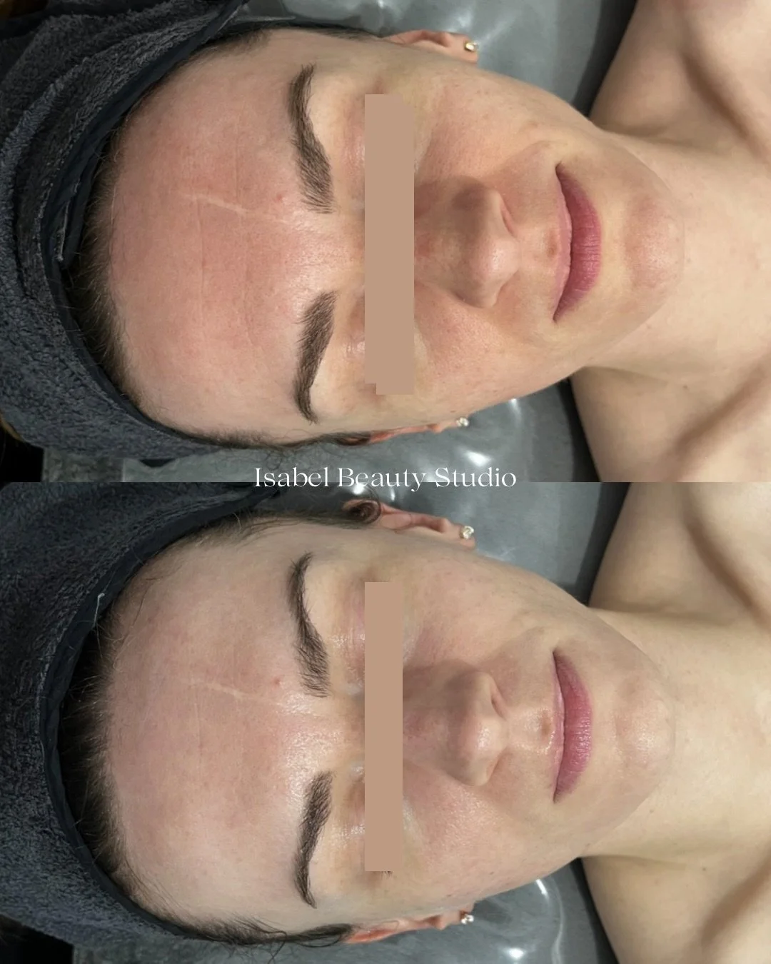 Before-and-after close-up of a woman’s facial skin following a beauty treatment, showing a smoother, brighter complexion.