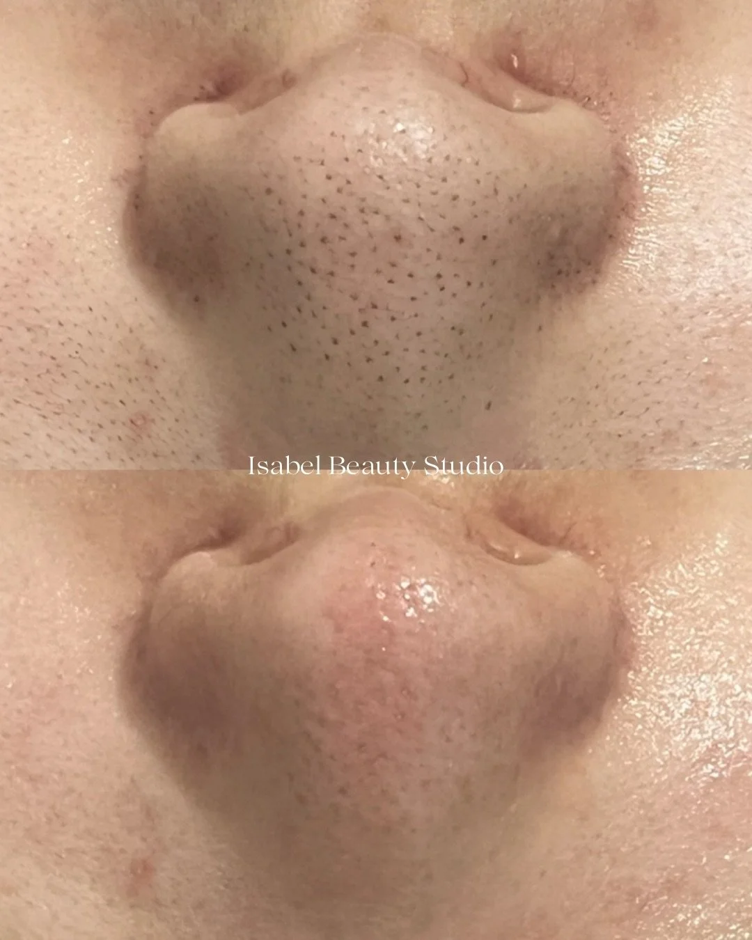 Before-and-after close-up of a nose showing reduced blackheads and smoother skin after beauty treatment