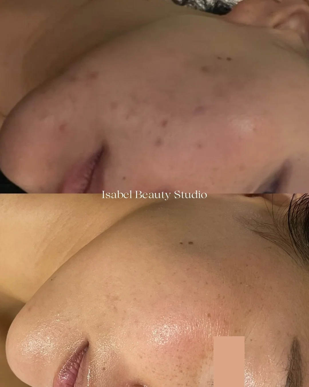 Before-and-after close-up of facial skin showing improved texture and reduced blemishes after an Isabel Beauty Studio treatment