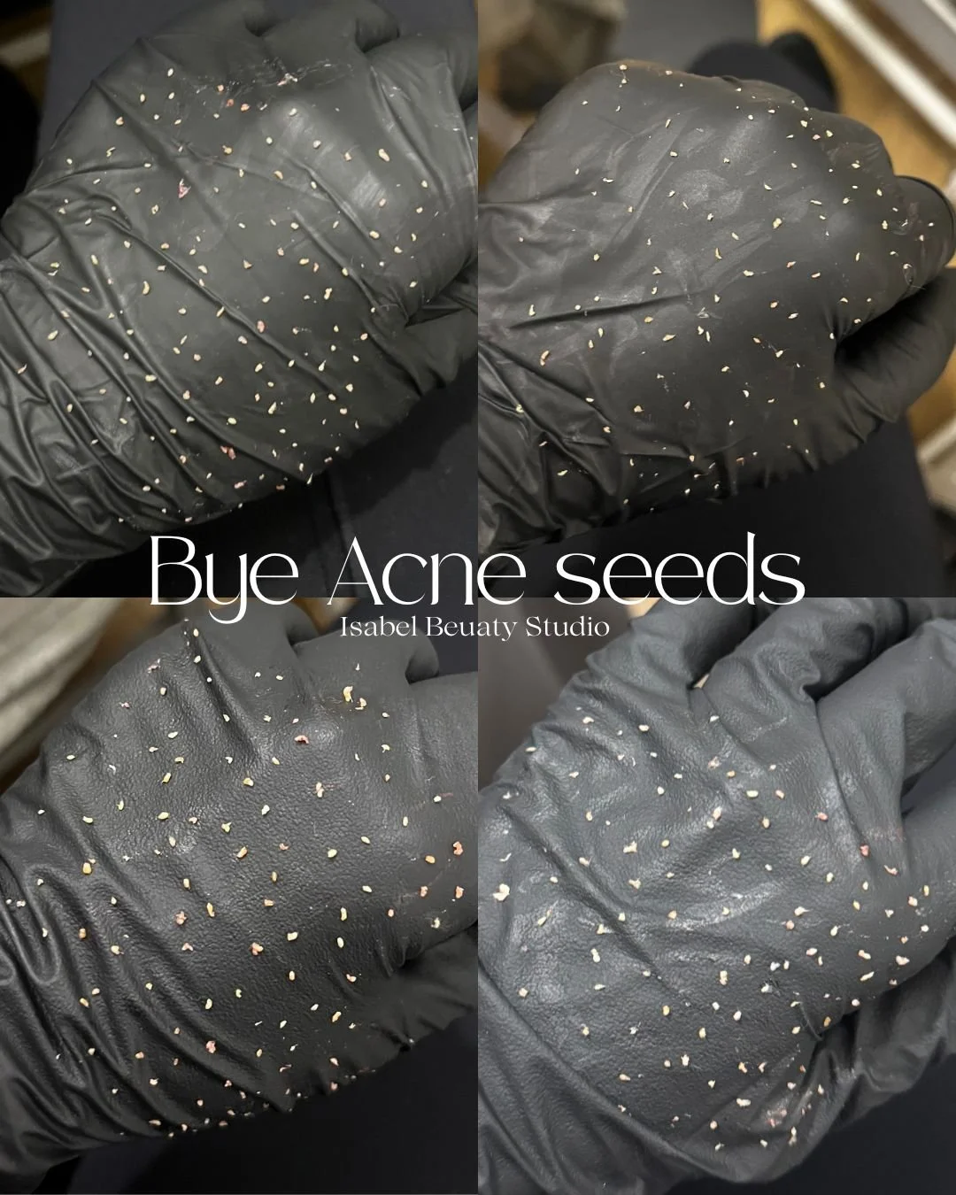 Collage of black-gloved hands covered with exfoliated acne seeds, labeled “Bye Acne Seeds” by Isabel Beauty Studio.