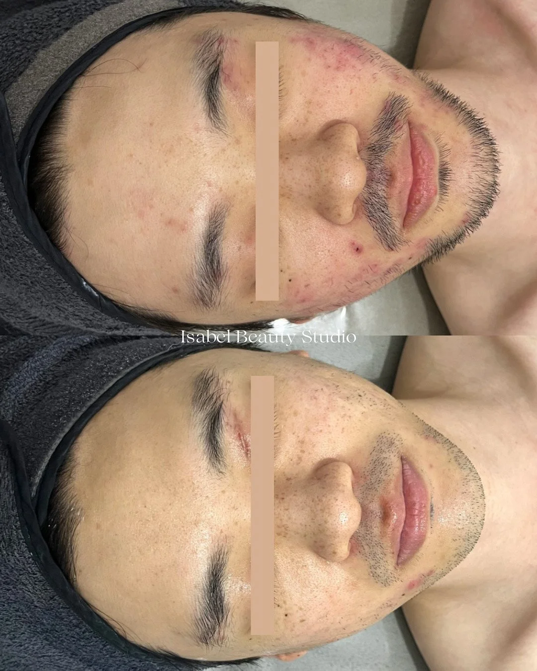 Before-and-after facial skincare treatment showing a man with acne-prone skin, facial redness, and beard stubble.