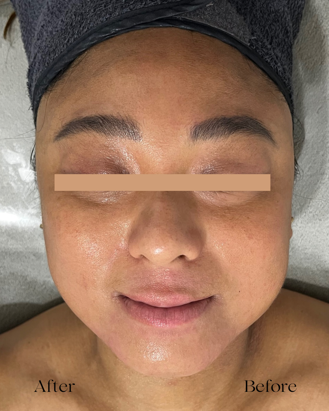 Close-up before-and-after facial skincare treatment photo showing a woman with eyes covered by a privacy bar and a towel-wrapped head