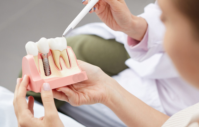 Wat zijn implantaten?