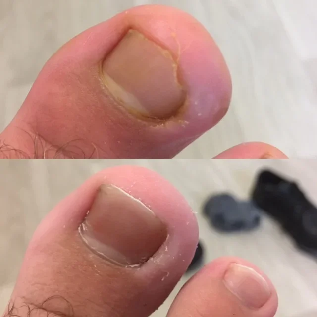 Perth Nail Surgery Clinic Leederville Pulse Podiatry nail surgery podiatrists Burke Hugo Heidi Chin