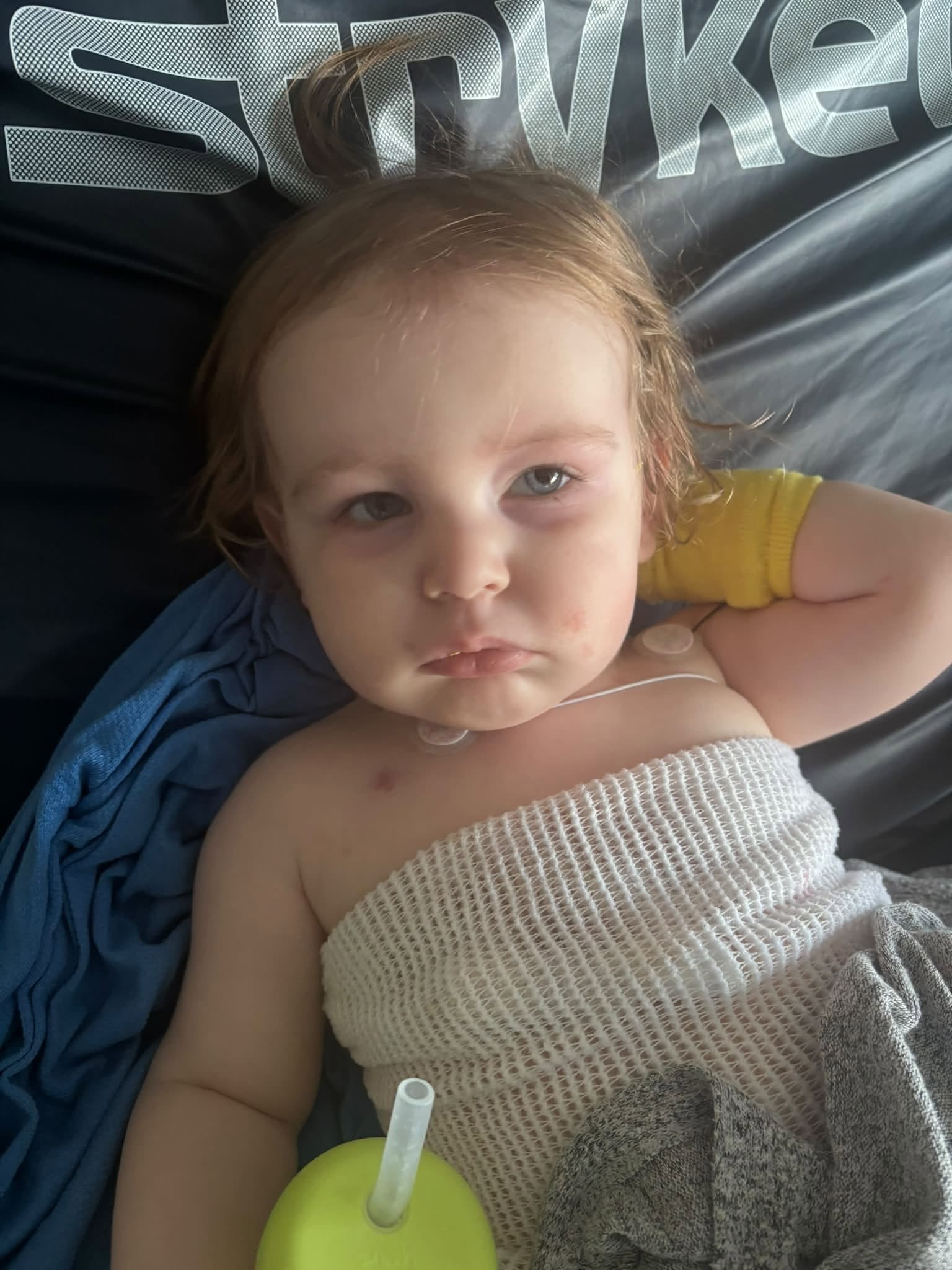 A young child with red hair and blue eyes lying on a hospital bed, wearing a yellow shirt and a beige mesh arm cast with gray cloth wrapped around it, with a straw cup near the arm.