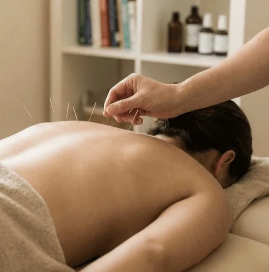Acupuncture