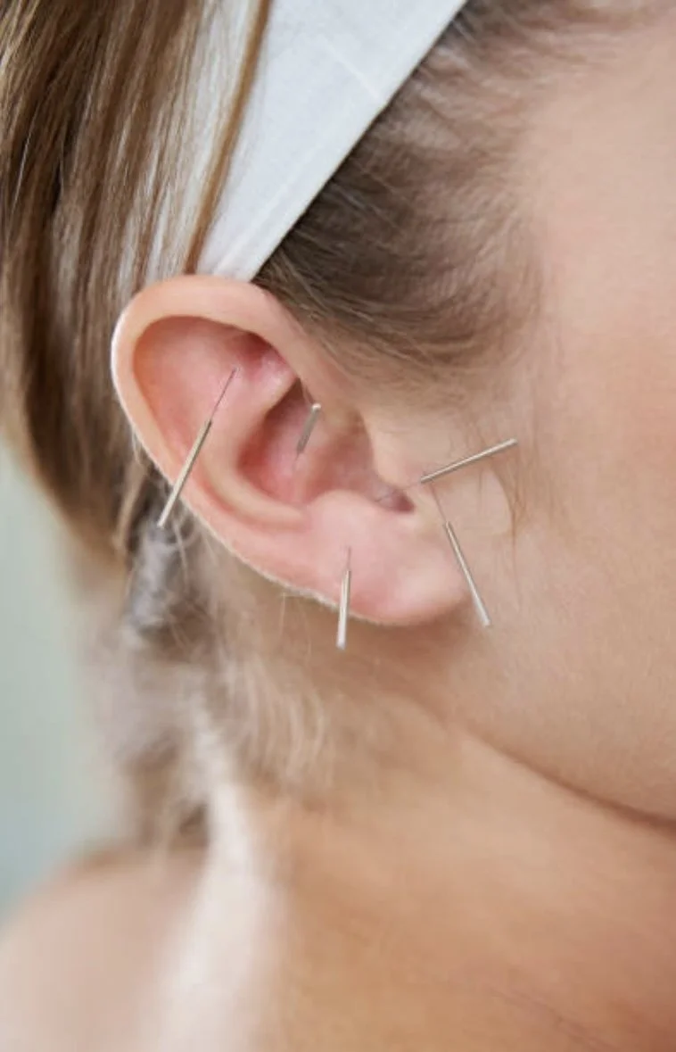 Auricular Acupuncture