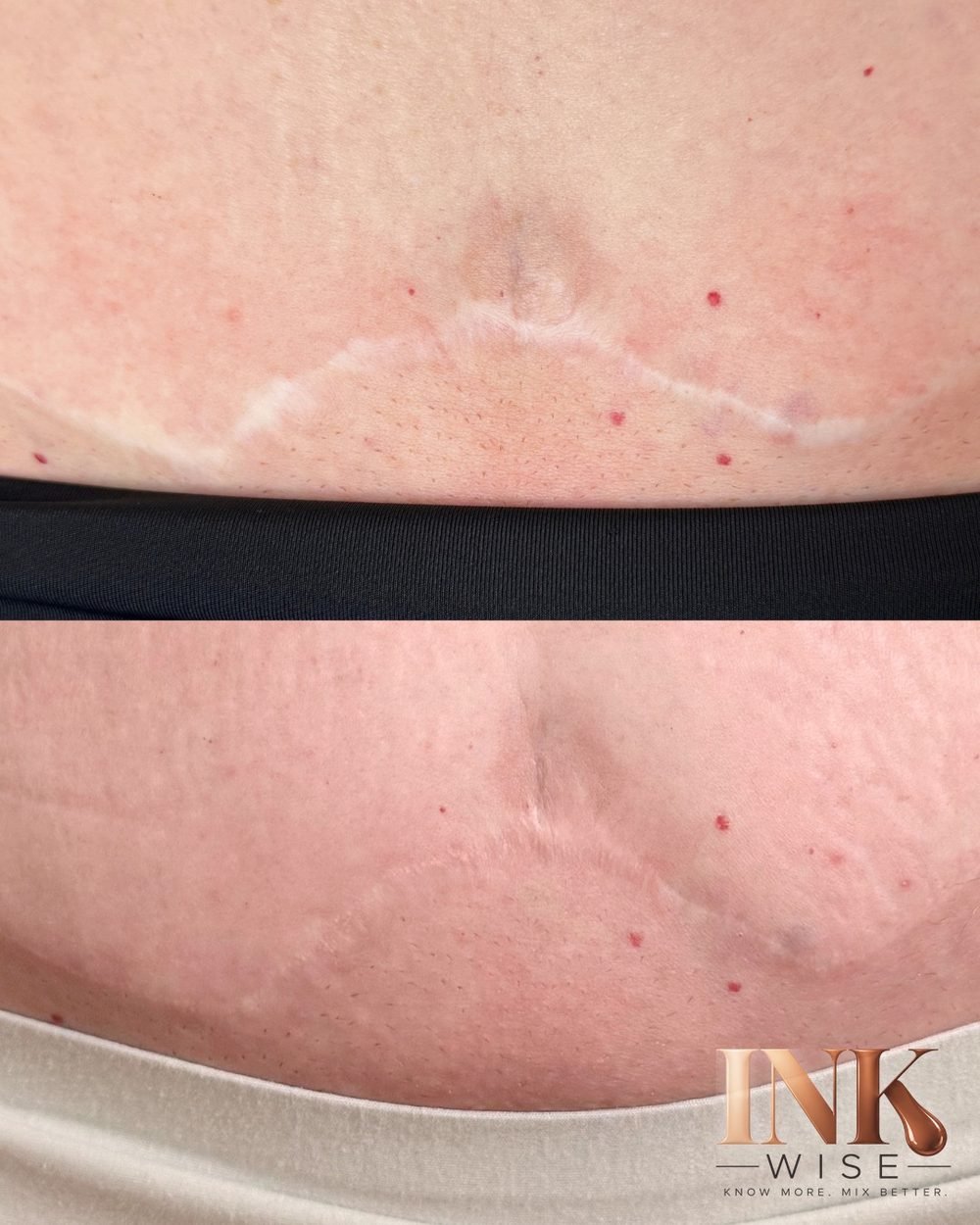 Scar camouflage before and after with well-balanced organic pigments