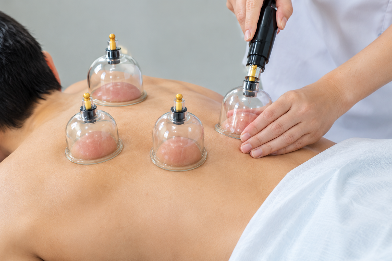 Practitioner using suction cups for cupping therapy on a patient's back