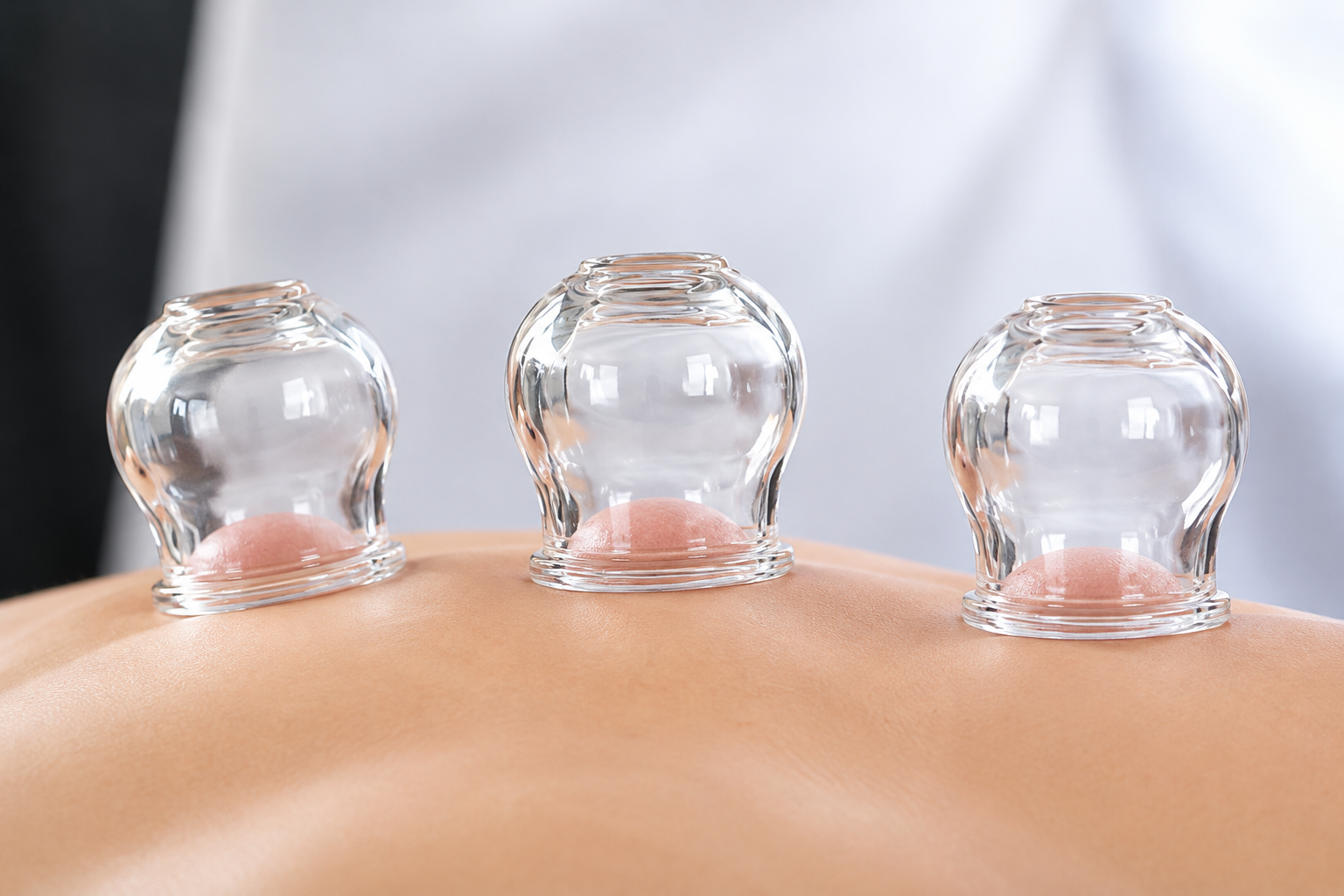 Cupping therapy using glass cups placed on a patient's back.