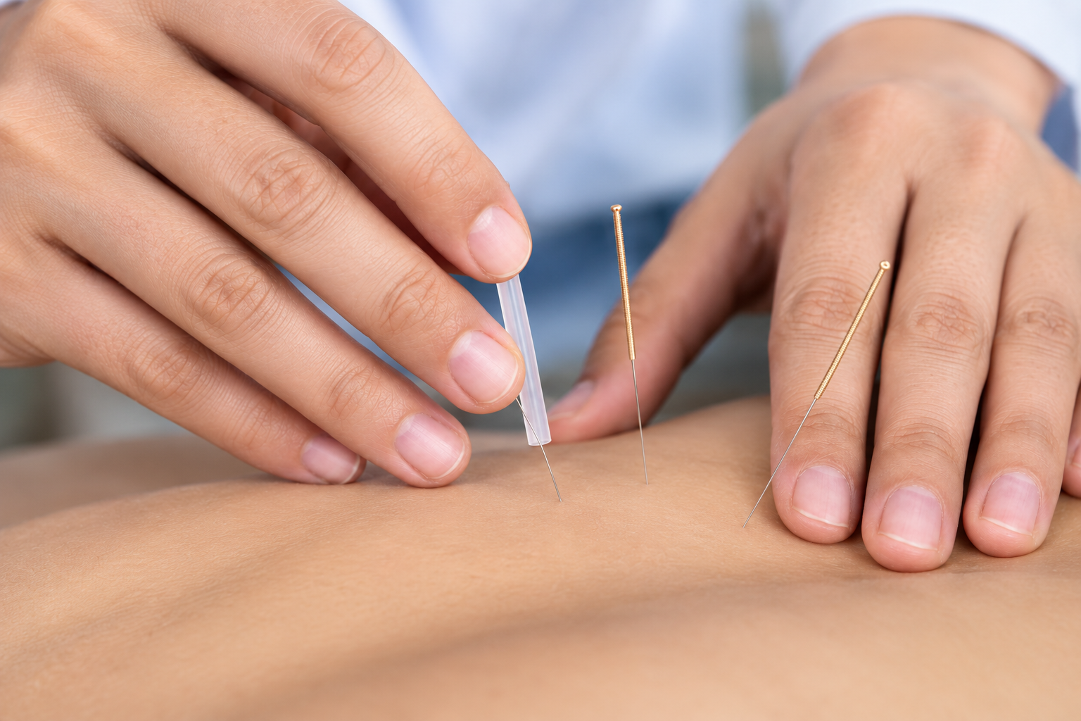 Acupuncturist inserting thin needles into a patient's back
