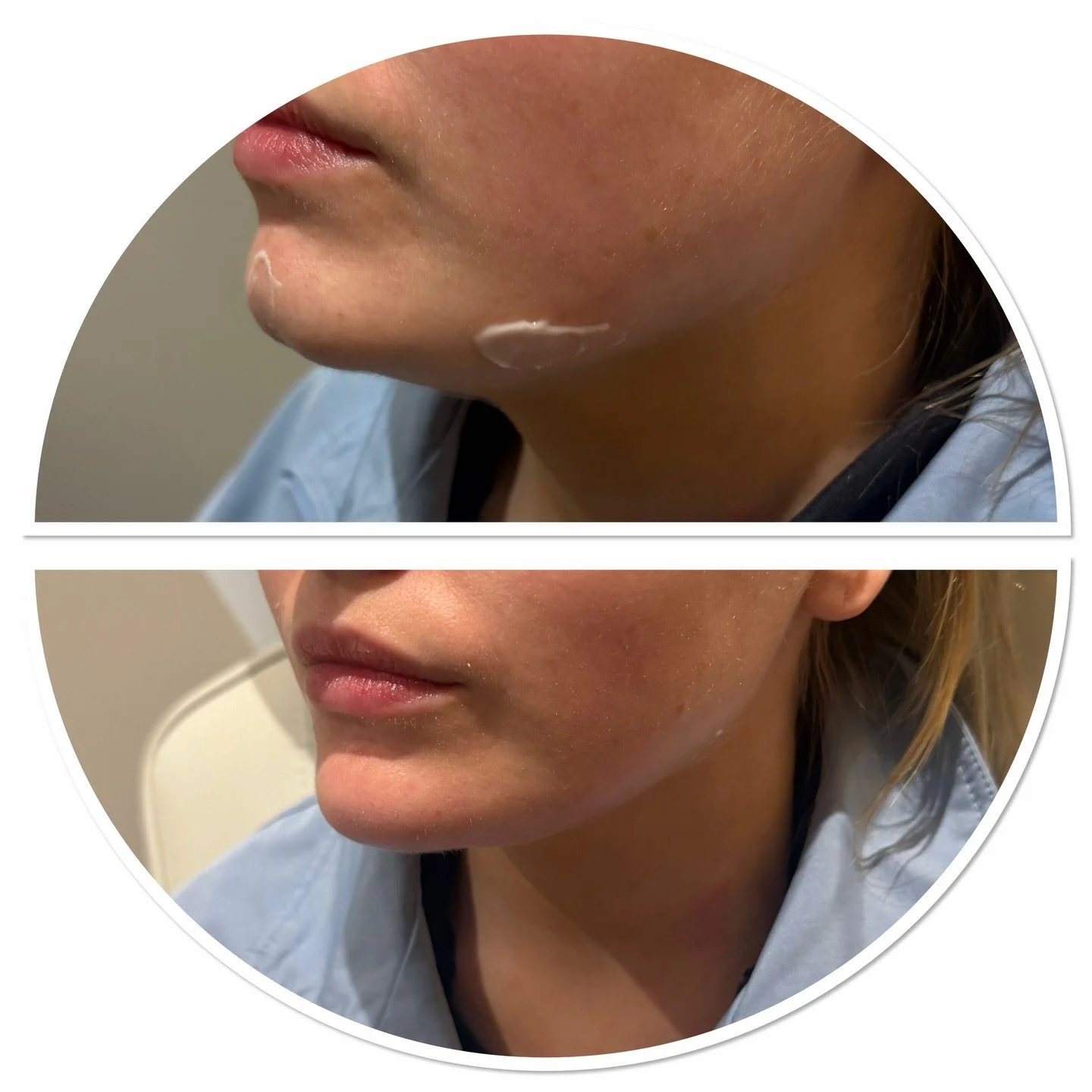 Subtle cleft chin correction , 1ml used here to fill in the cleft on the chin and add some structure to the pre jowl. #chinfiller #cleftchin