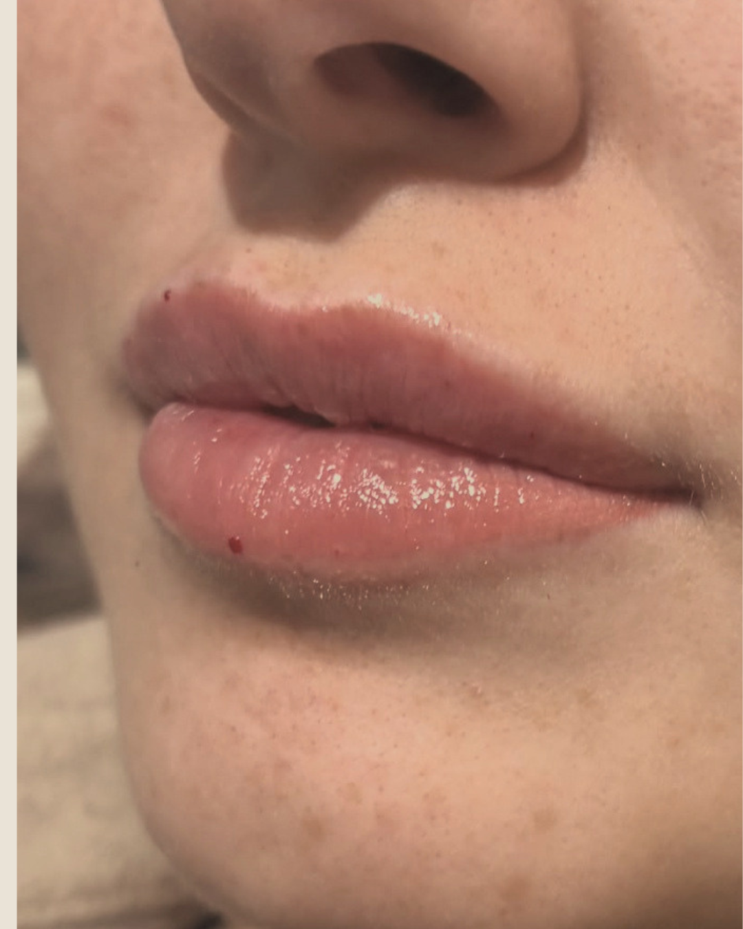 Close-up of natural-looking lip filler results