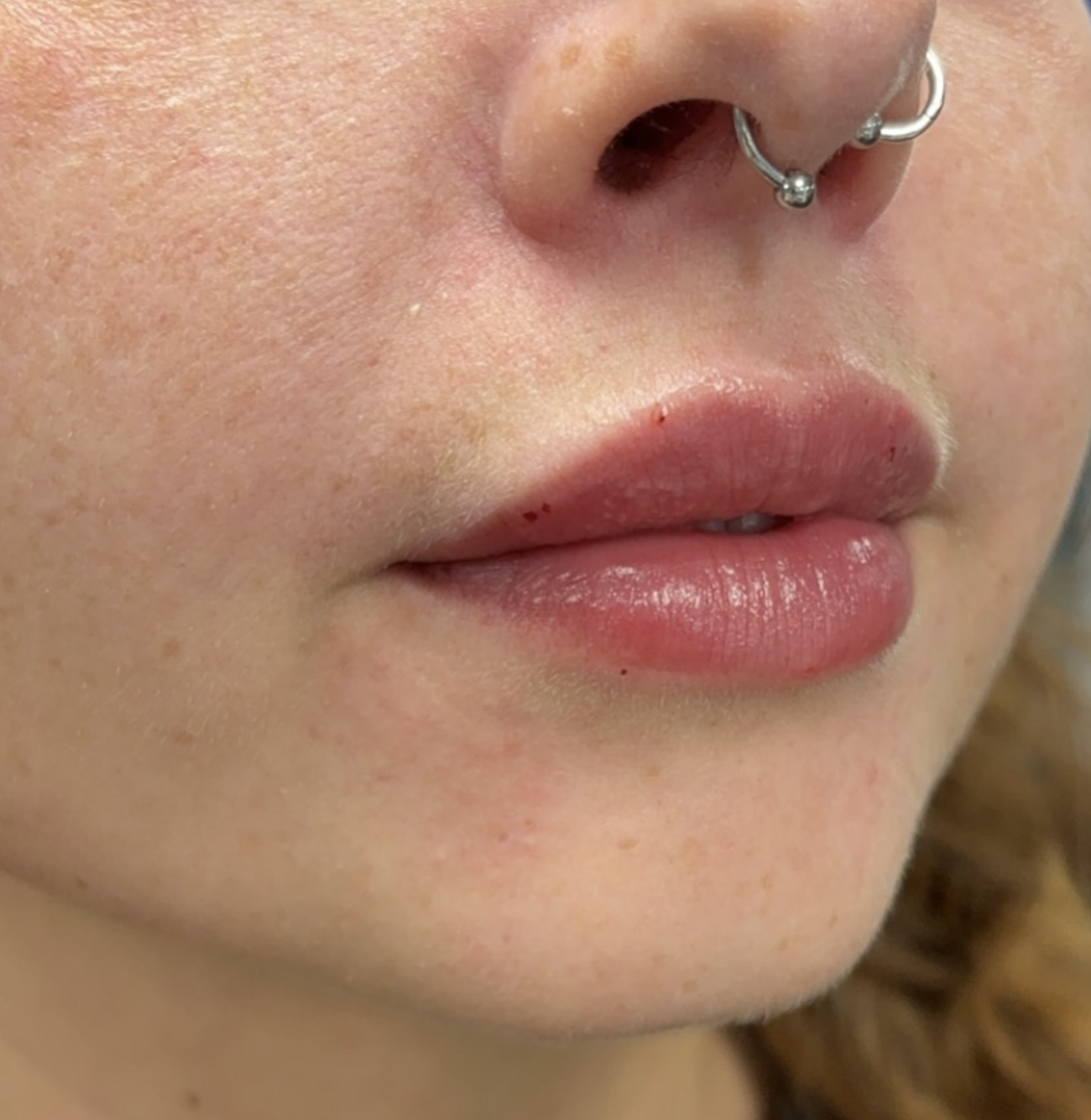 Close-up of a person's face showing mouth, nose, and lips with a septum piercing; small cuts or blemishes on lips.