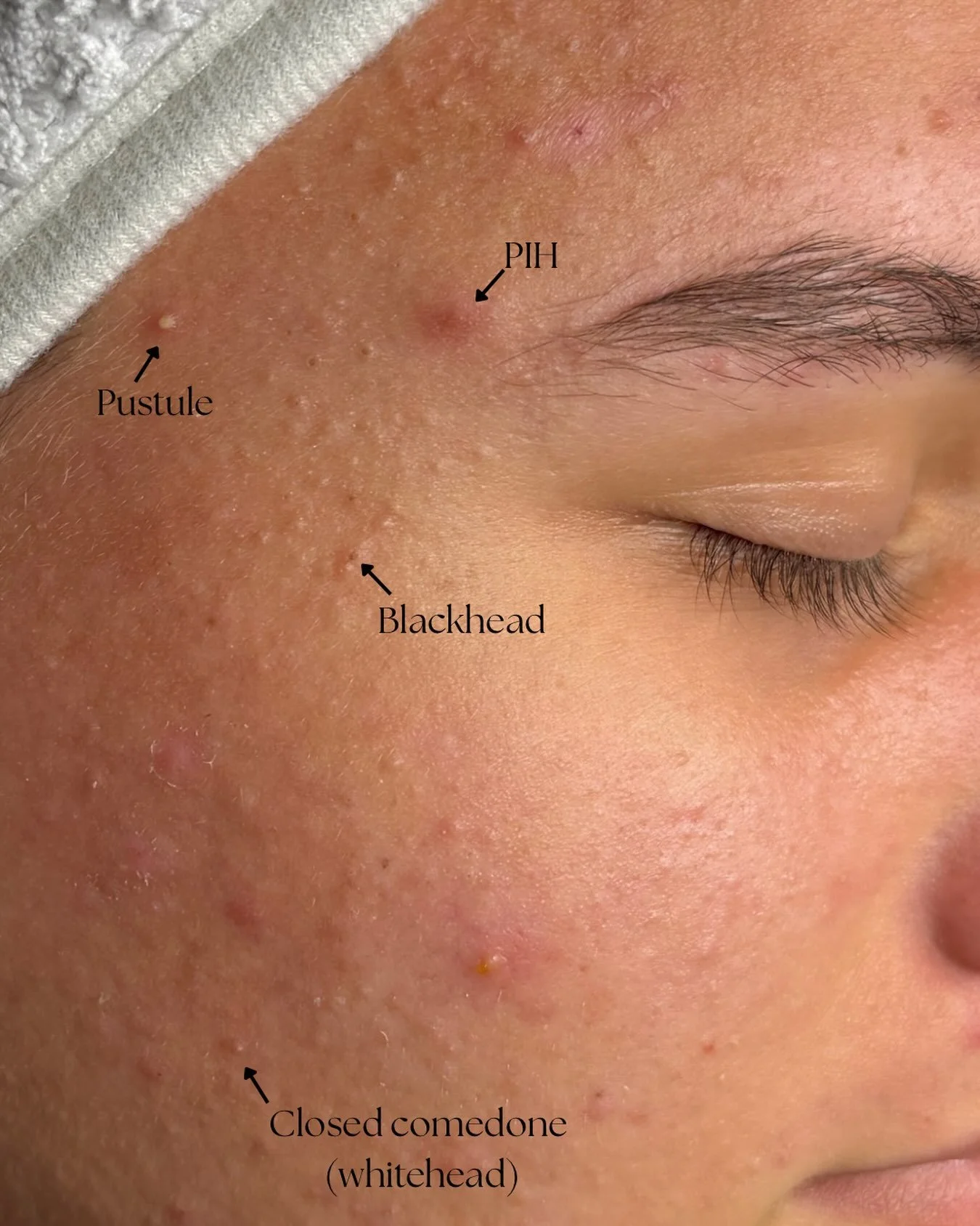 A closer look at common skin concerns 🔍✨ 

Not every bump or mark is the same&mdash;and knowing the difference matters when creating an effective treatment plan.

🤍 Pustule: inflamed lesion containing pus
🖤 Blackhead: open clogged pore
🤍 Closed c