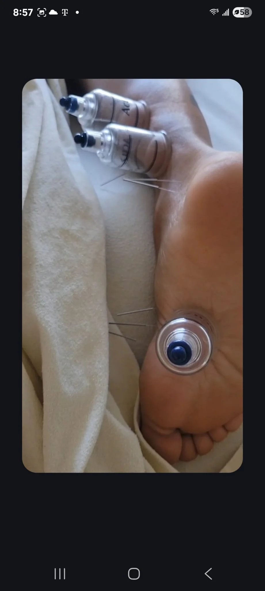 Acupuncture Plus Cupping