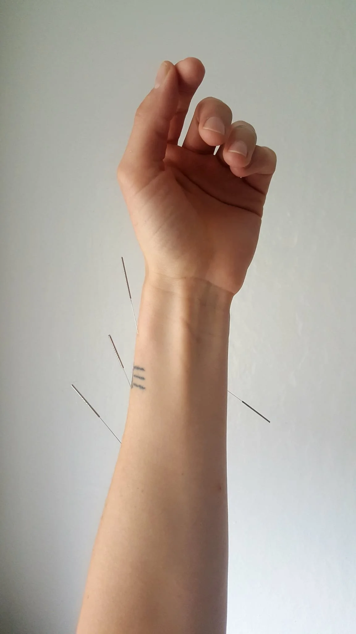 Acupuncture