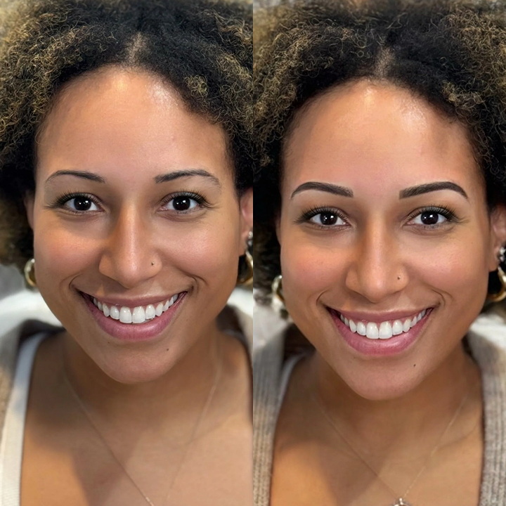Side-by-side comparison of a woman before and after dental cosmetic treatment, showing a brighter, more aligned smile in the after photo.