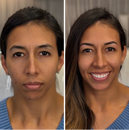 Side-by-side comparison of a woman before and after skincare, showing clearer and more even skin, and a noticeable smile.