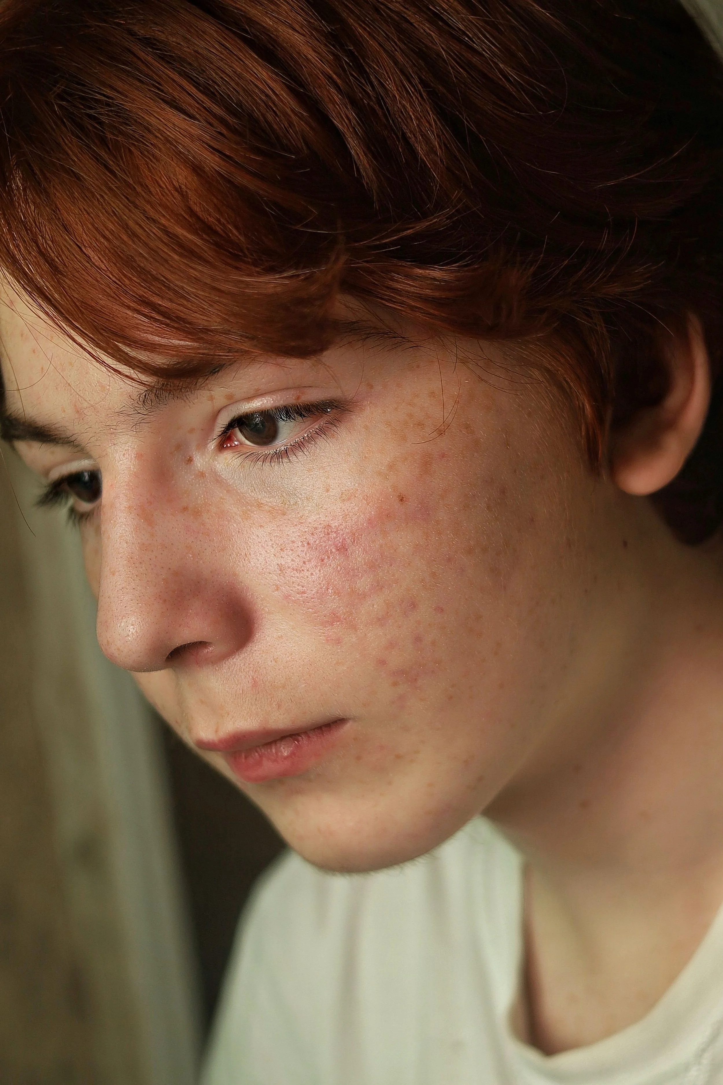 Close-up of a person with brown hair, brown eyes, and visible facial acne