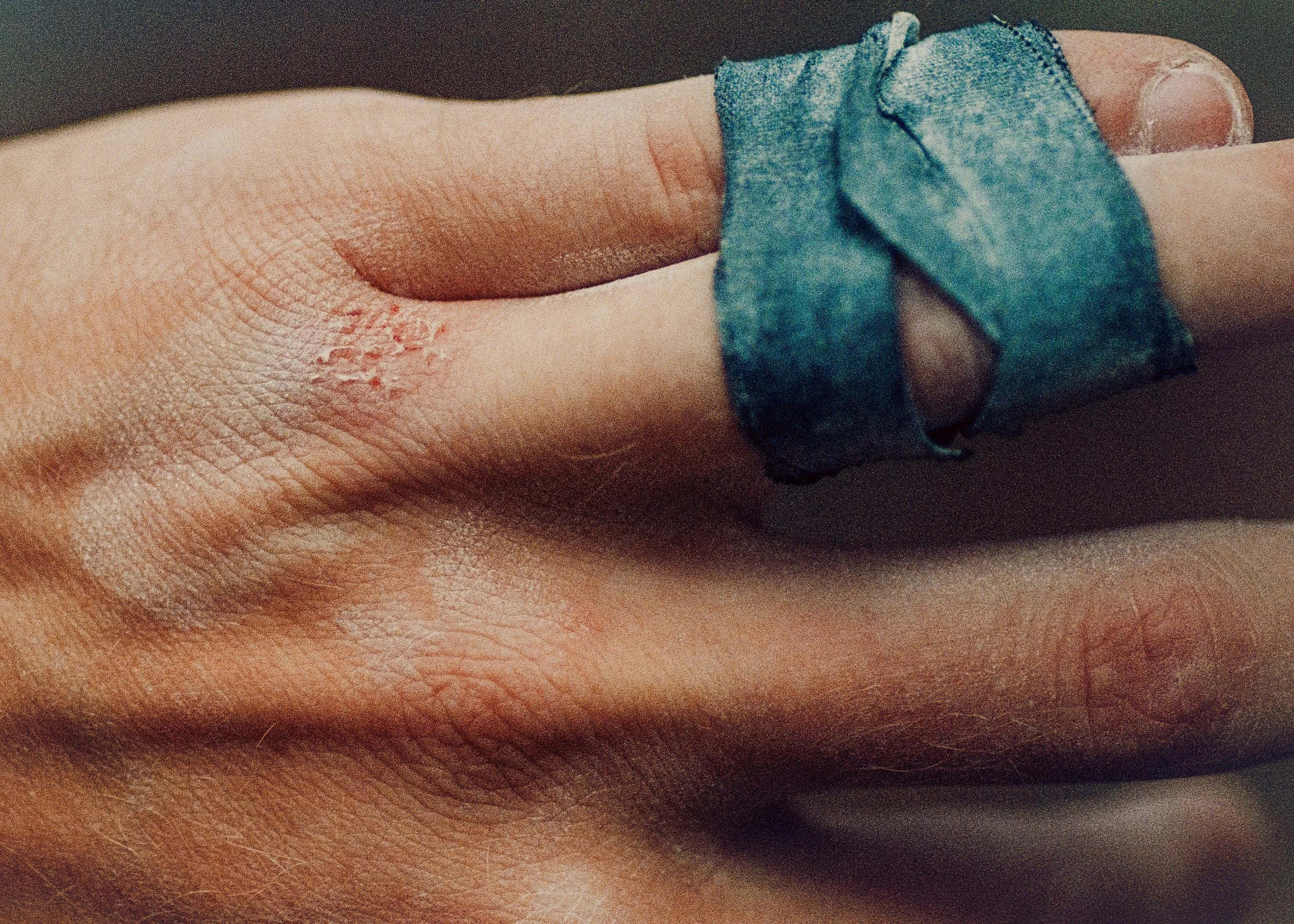Rock Climbers Hand with injury