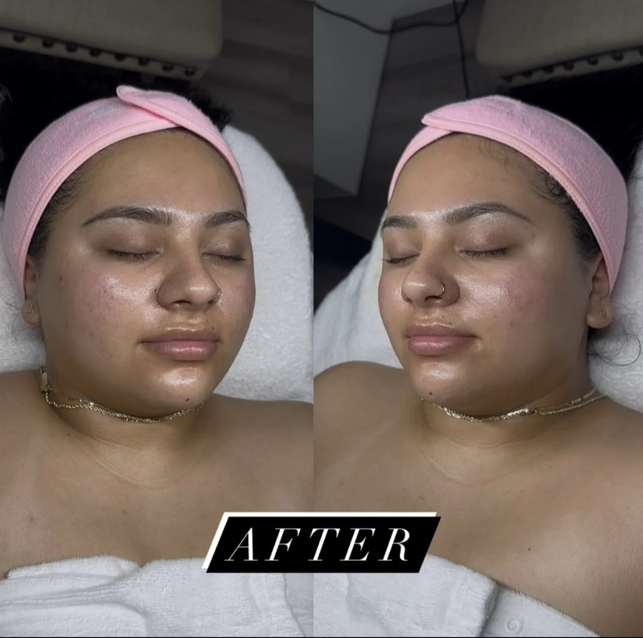 Before-and-after close-up of a woman wearing a pink headband, showing glowing facial skin after a skincare treatment.