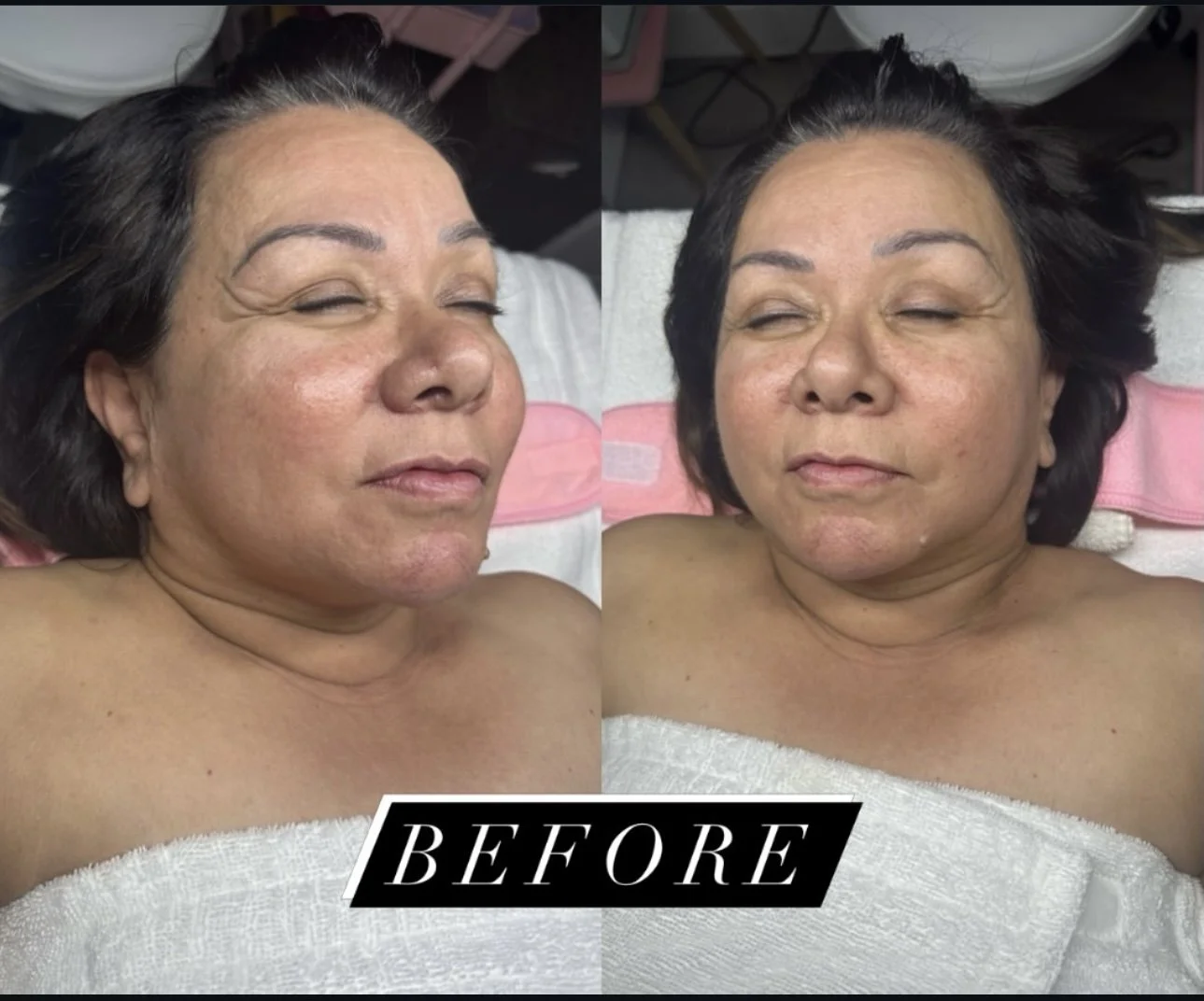 Before-treatment split-screen portrait of a woman reclining on a spa bed, showing facial wrinkles and fine lines