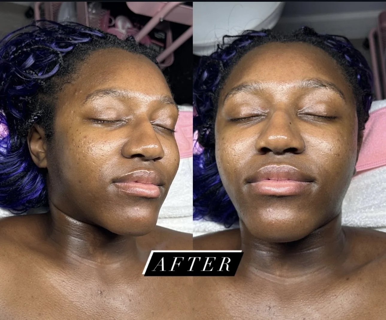Before-and-after close-up photos of a Black woman with purple braids and closed eyes, showing smoother, glowing facial skin after a skincare treatment.