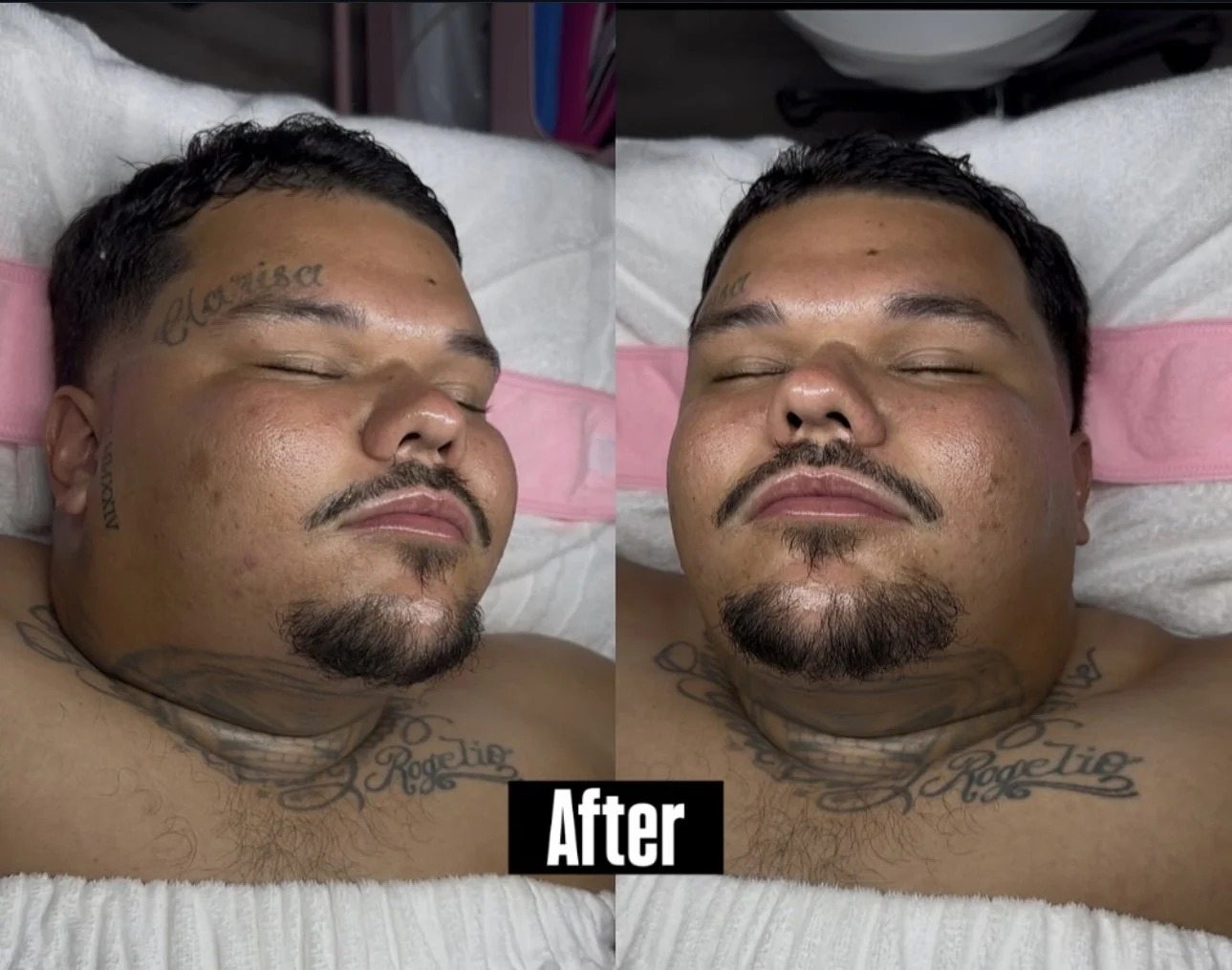 Before-and-after-style split image of a tattooed man with closed eyes and a trimmed mustache and goatee lying on a treatment bed, labeled “After.”