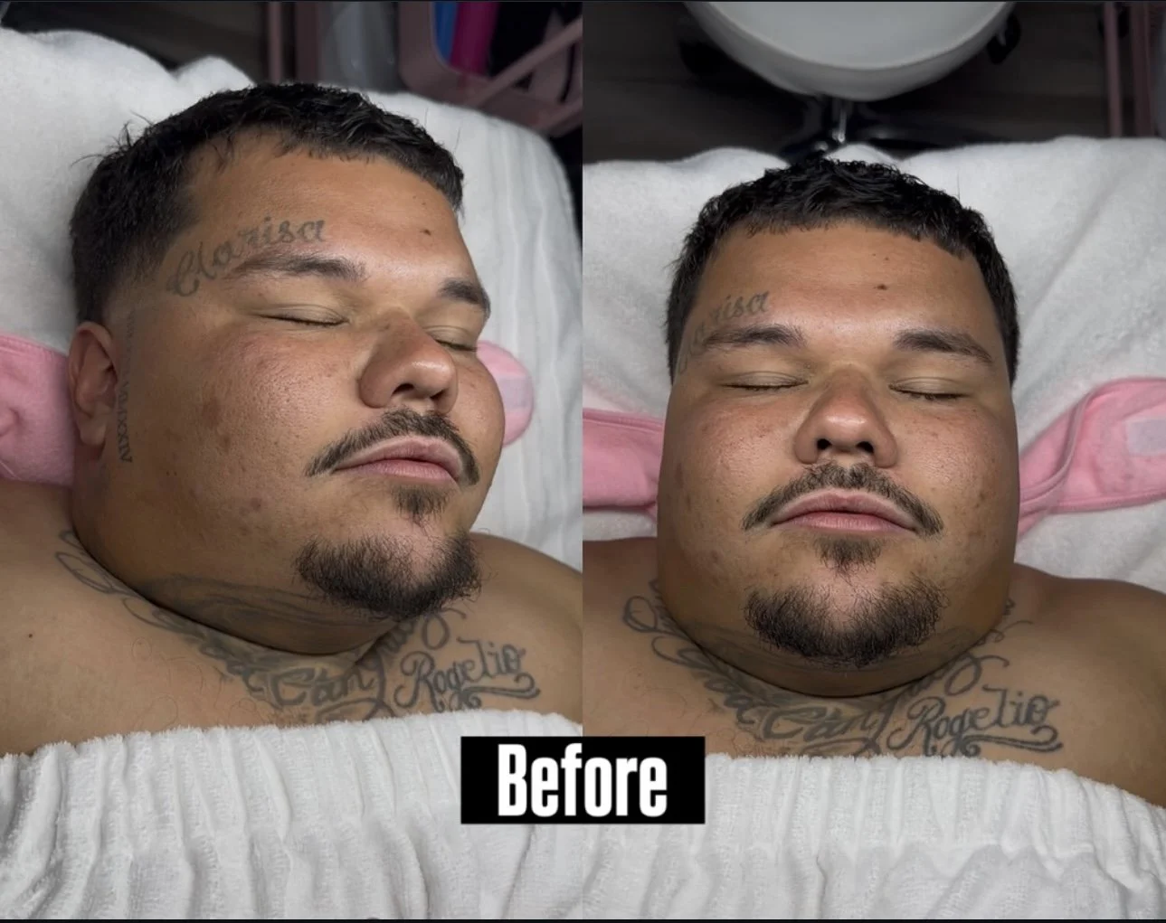 Before photo of a tattooed man with closed eyes and a goatee lying on a treatment bed.
