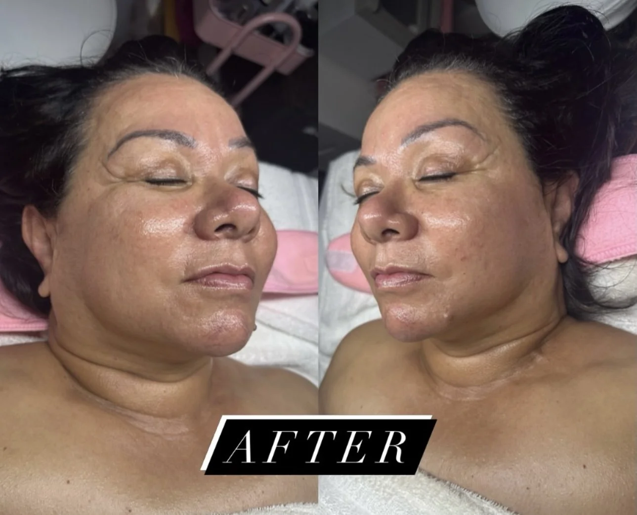 Split before-and-after close-up portraits of a woman lying down, labeled “AFTER,” showing smoother facial skin and reduced wrinkles.