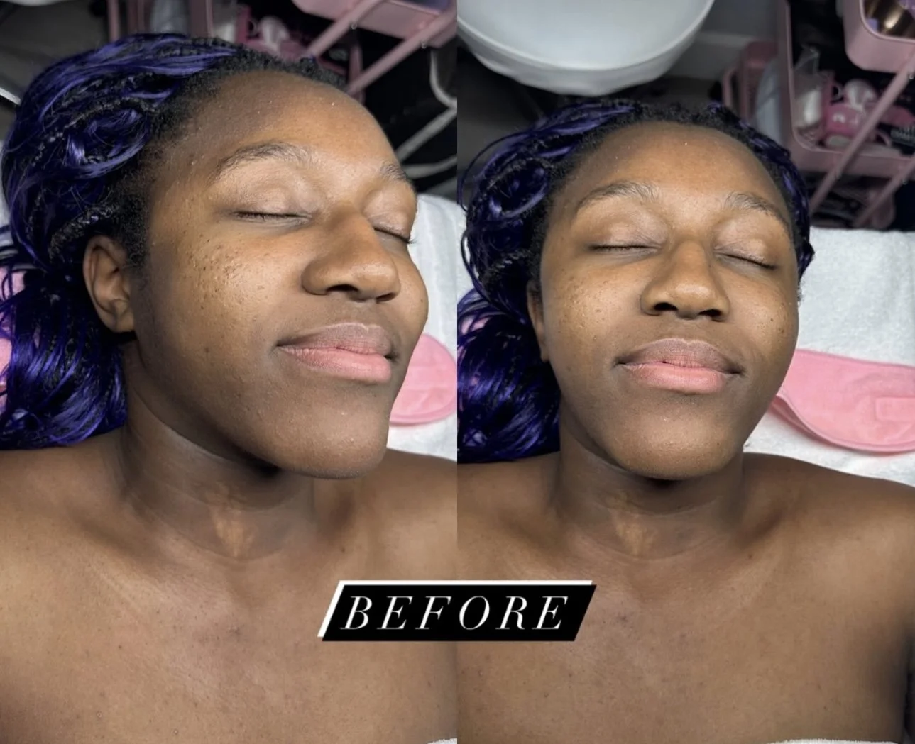 Before-treatment collage showing a Black woman with purple braided hair and closed eyes, viewed from angled and front-facing perspectives.