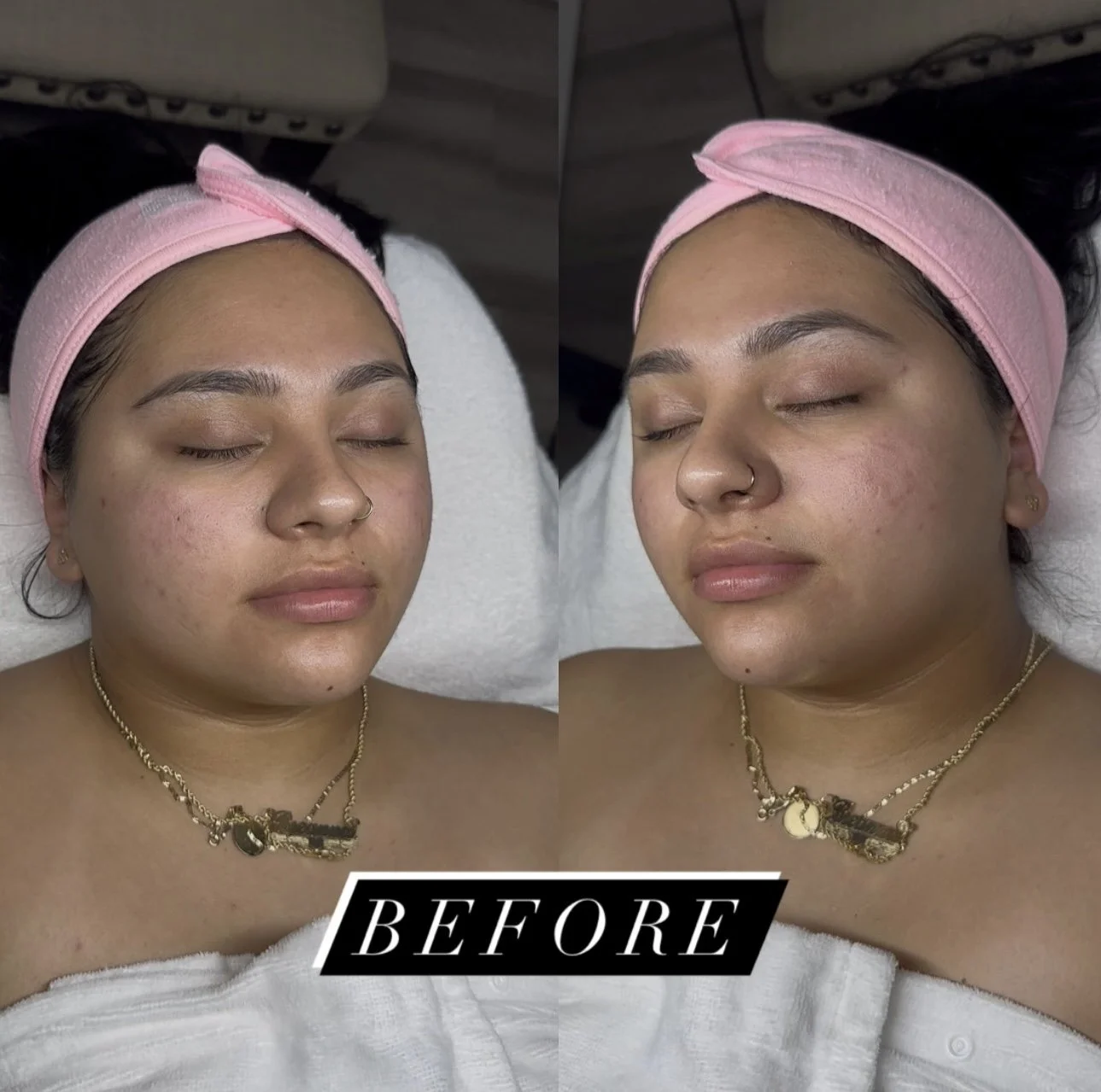Side-by-side before photos of a woman wearing a pink headband and lying down for a skincare treatment.