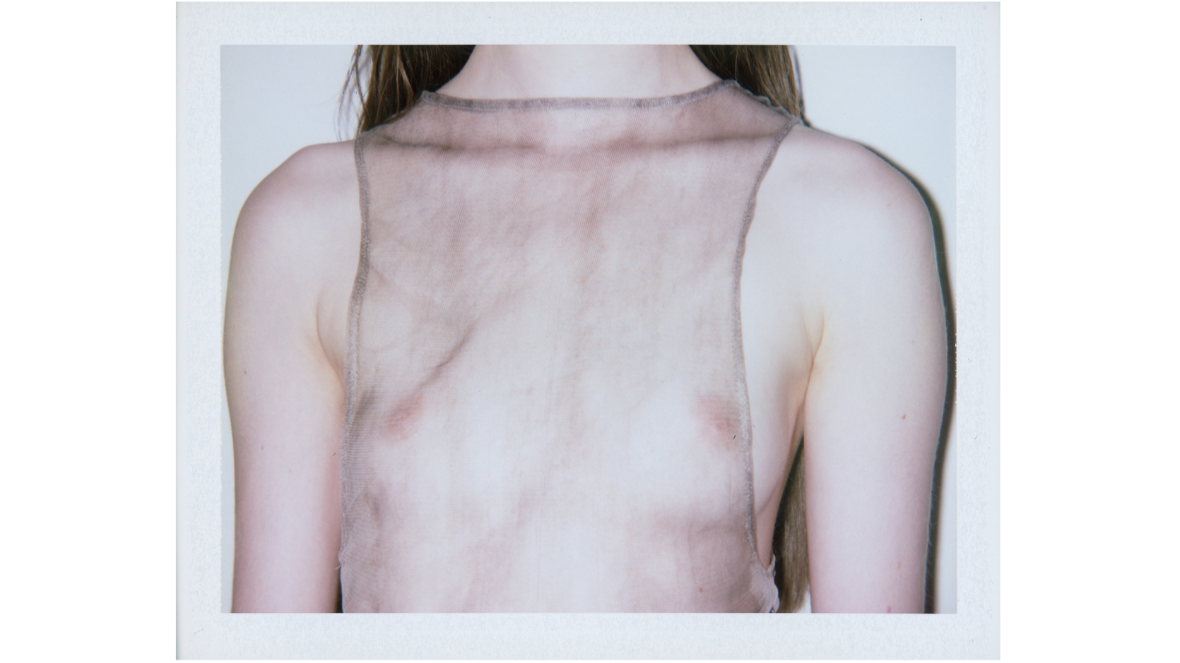 Close-up of a person’s upper back showing patchy reddish-purple skin discoloration beneath a sheer sleeveless top