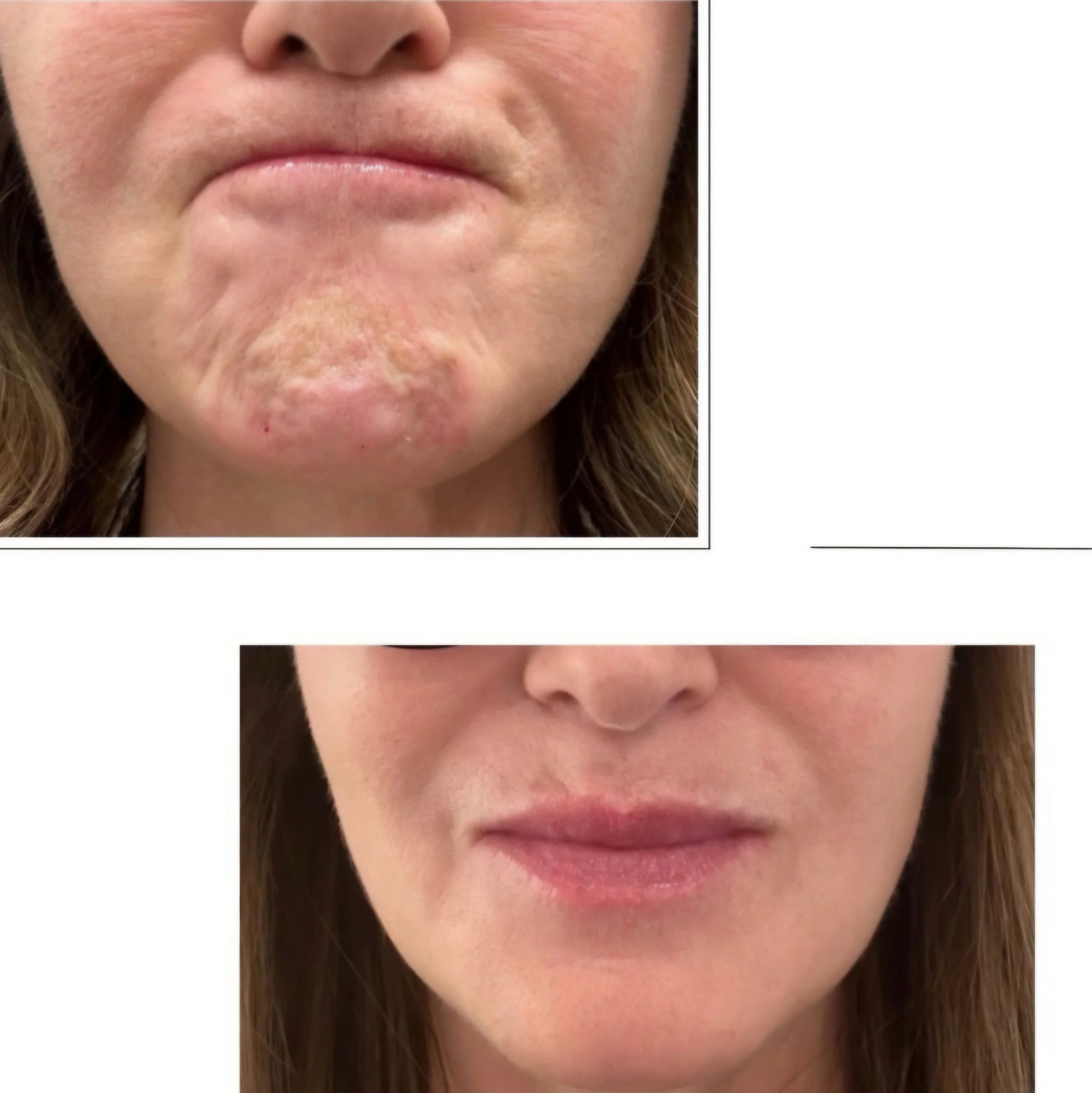 Chin Botox