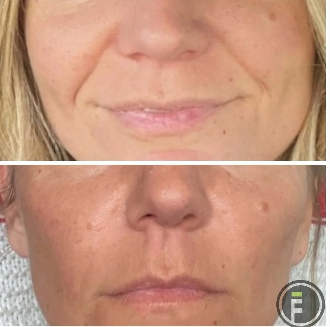 Nasolabial Fold and Cheek Filler