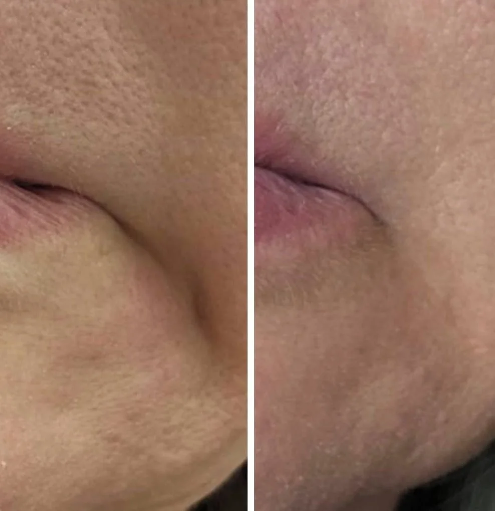 Marionette Line Botox