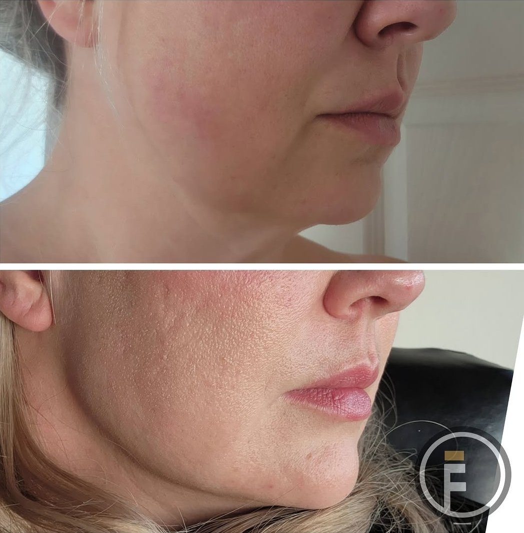 Chin and Jaw Filler
