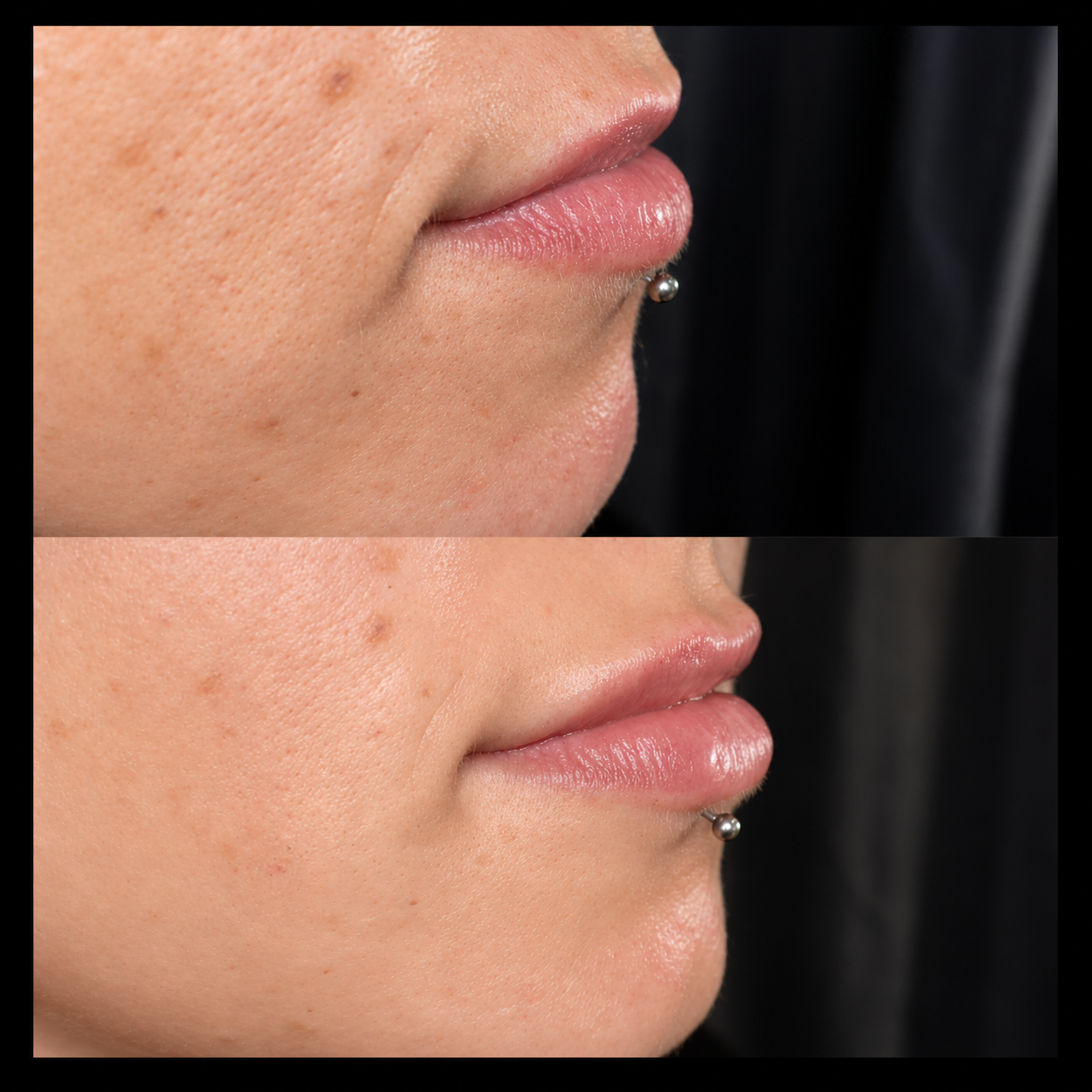 Chin Filler