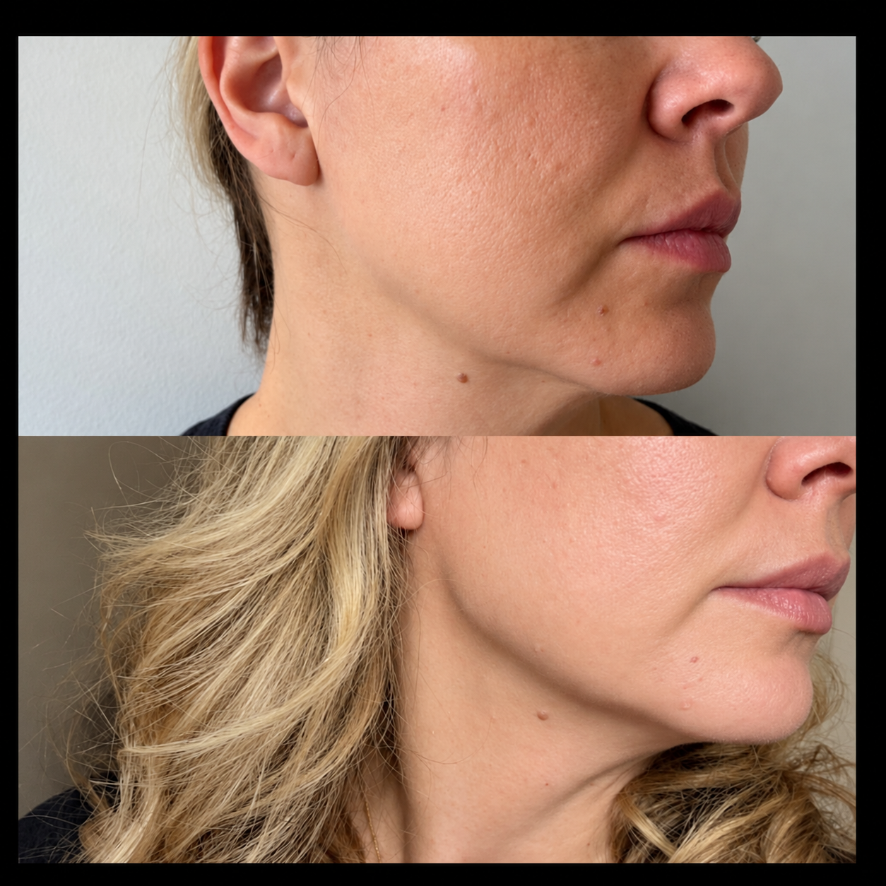 Jaw Filler