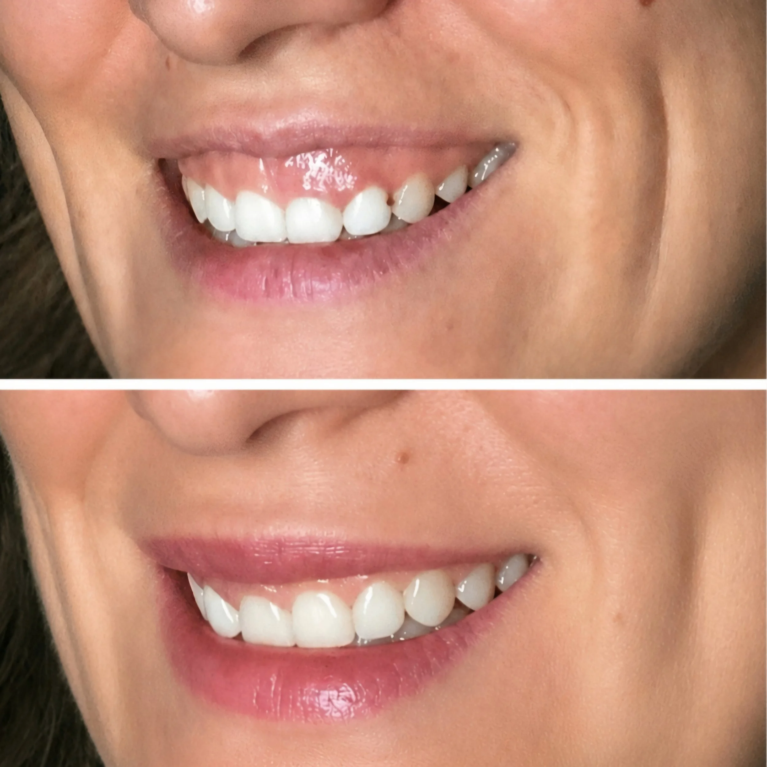 Gummy Smile Botox