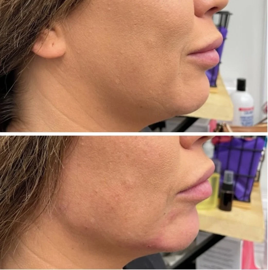 Chin and Jaw Filler