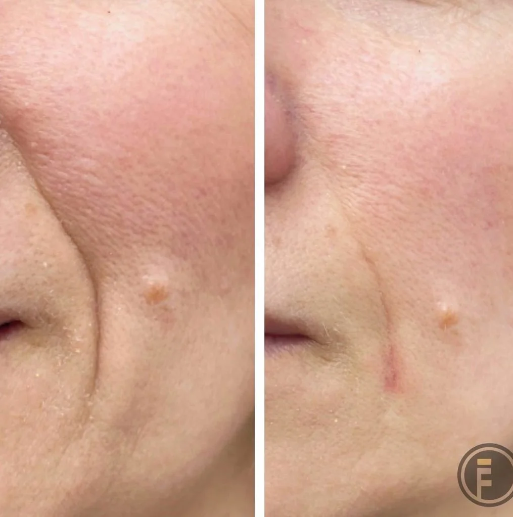 Nasolabial Fold Filler
