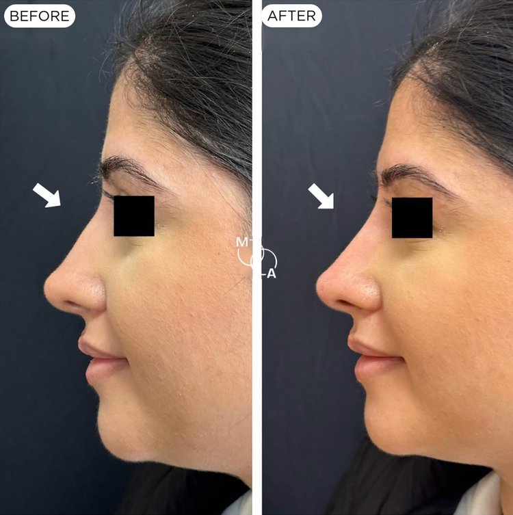 Non-surgical rhinoplasty before and after, profile view, Mindful Aesthetics Reigate