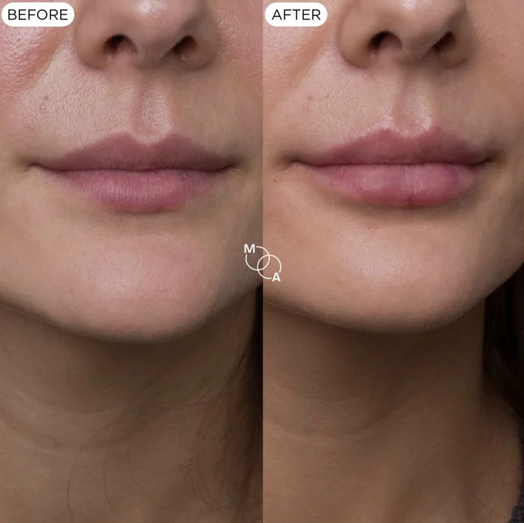 Lip filler before and after, border definition, Mindful Aesthetics Reigate