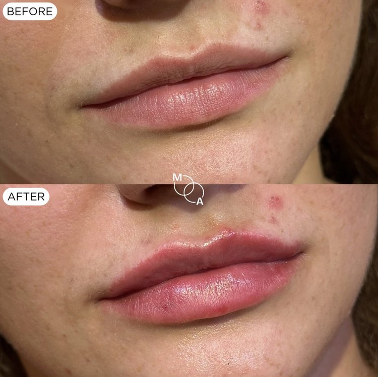 Lip filler before and after, upper and lower lip balance, Reigate Surrey